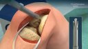An Animated Overview of the NAVIO Surgical System